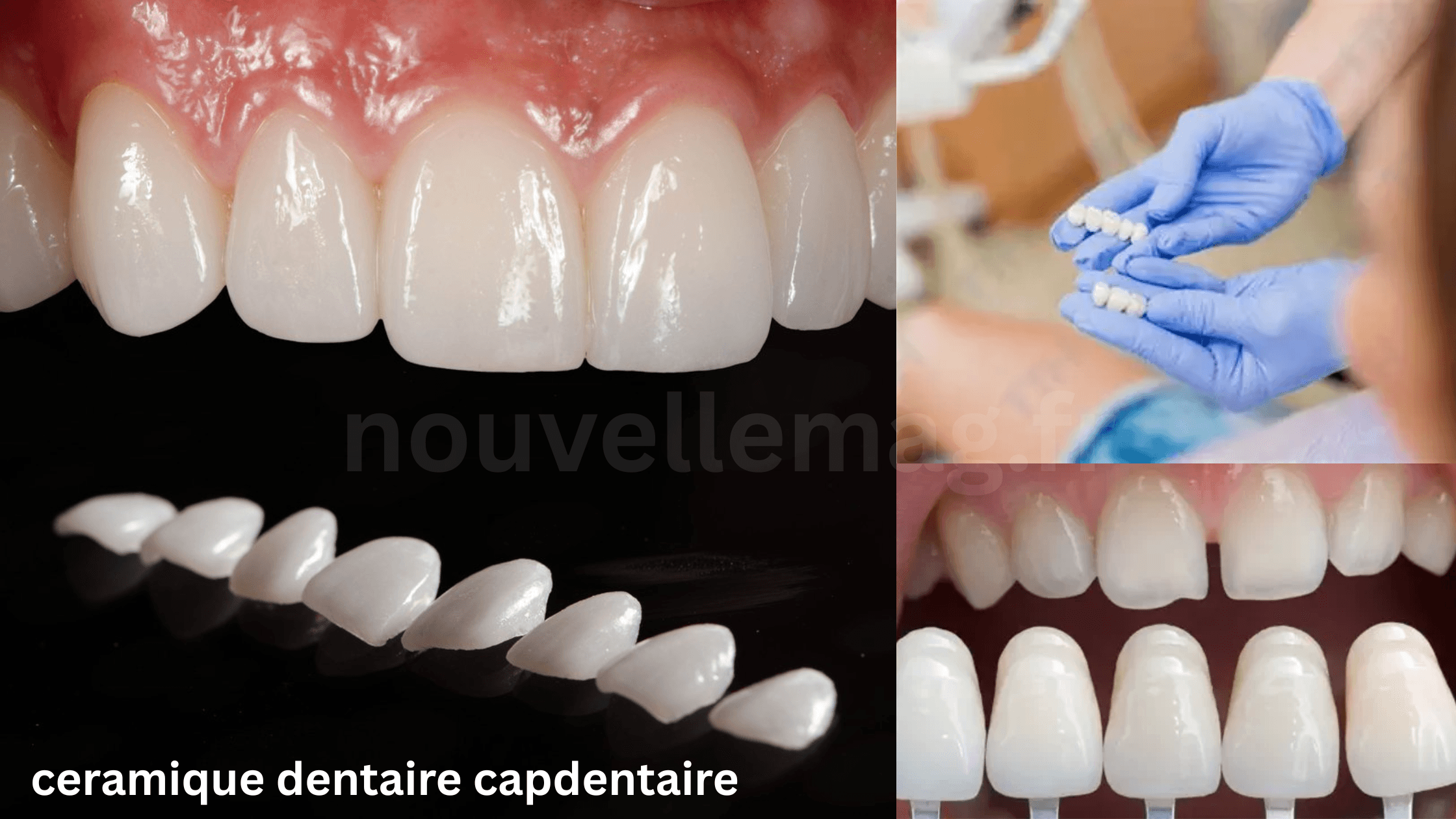 ceramique dentaire capdentaire